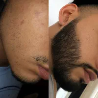 پرپشتی در سریعترین زمان