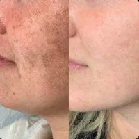 تخفیف بهاره پاکسازی تخصصی و فیشال صورت