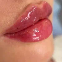 تزریق ژل و فیلر،بوتاکس،کاشت نخ،پیرسینگ،مزو