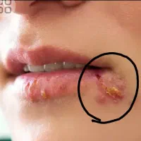 رفع همیشگی زگیل و تبخال