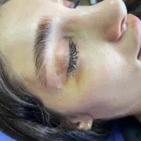 بلفاروپلاستی و  دایرکت ابرو با بخیه لیزری