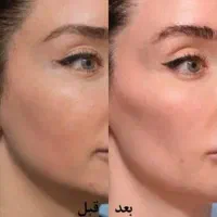 تزریق ژل و بوتاکس انواع برندمعتبر فقط هزینه ی مواد