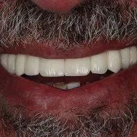 دندانپزشکی حرفه ای‌ ایمپلنت تخصصی با اقساط طولانی