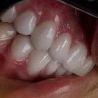 دندانپزشکی/ کامپوزیت/عصب کشی/روکش  این متن اولیه