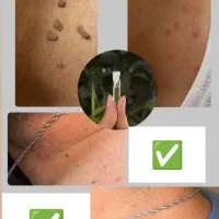محلول معجزه برطرف کننده انواع منگوله پوستی