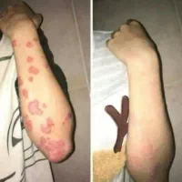 درمان تضمینی بیماری های خودایمنی،پیسی،روماتیسم