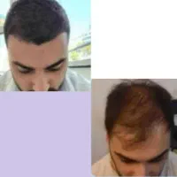 قطعی ریزش،ایجاد رویش