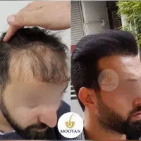 جشنواره‌کاشت‌مو(VIP)۲۴تومن کاشت ابرو۱۴‌(اقساط)