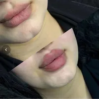 تزریق ژل لب بینی چشم بوتاکس و زاویه سازی ولیزر