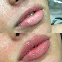 تزریق بوتاکس ۱/۴۰۰ هر سه نفر معرفی رایگان