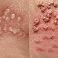 برداشتن زگیل تناسلی میخچه خال گوشتی