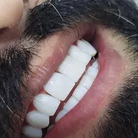 کامپوزیت دندان|خدمات آرایشگری و زیبایی|تهران, هفت حوض|دیوار