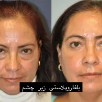 جشنواره بلفاروپلاستی،ساکشن غبغب،بوکال،سانترال لب