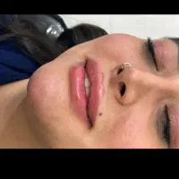 آموزش فیلر و بوتاکس و مزوتراپی توسط متخصص زیبایی