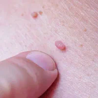 درمان زگیل تناسلی تنها در یک جلسه بدون نقاهت|خدمات زیبایی و سلامت|کرج, اصفهانی‌ها|دیوار