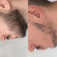 ریش مو ریزش سکه ای