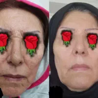 کرم بیوممتیک ۵کاره قویتر از بوتاکس قیمت قبل+هدیه