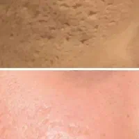 فیشال و درمان انواع عارضه های پوستی