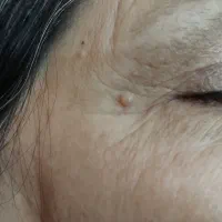 از بین بردن خال گوشتی زگیل میخچه کاملا تضمینی