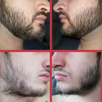 رویش ریش و سبیل
