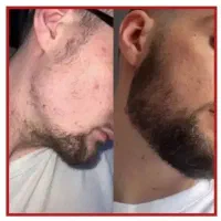 ریش سیبیل ریزش سکه ای الوپسی