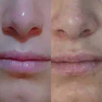 فیشیال و پاکسازی تخصصی پوست تخفیف ۵۰ درصد مفتح