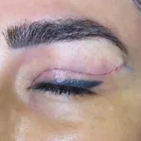 جراحی بلفاروپلاستی ( افتادگی پلک ) با بخیه لیزری