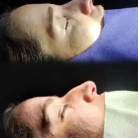 انواع عمل زیبایی در بیمارستان بینی.غبغب.بلفارو.ژل
