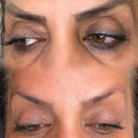 مرکز تخصصی ریموپاک کردن تتو صورت وآموزش