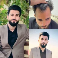 کاشت مو پرتراکم تضمینی بدون جراحی و اقساط