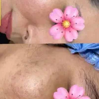 رفع کک و مک و لک های ملاسما و آفتاب سوختگی