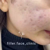 تخفیفات بوتاکس،پی ار پی،فیلر،فیشیال،مزو در مطب