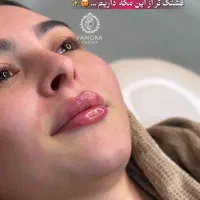 فیلر لب روسی فقط ۲/۲۰۰