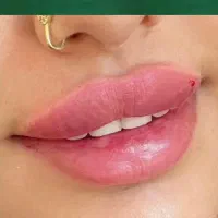 تزریقات زیبایی ژل و بوتاکس و مزوژل ها