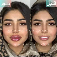 فیلر بینی ژل لب تکنیک M تخصصی تزریق فول فیس نچرال‌