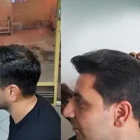 کاشت مو تخصصی با تخفیف تابستانه( بانک ضعیف  شقیقه