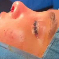 جراحی بینی ، پیکرتراشی ، لیفت صورت