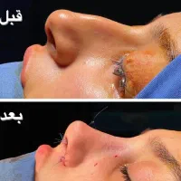 جشنواره عمل بینی بدون تامپون توسط فوق تخصص پلاستیک