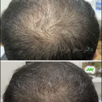 مزوتراپی مو، با تضمین بالای قطعی ریزش مو