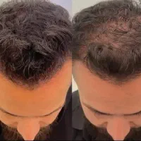 قبل اینکه مجبور بشی کاشت مو کنی ببین