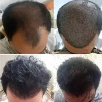 کاشت مو و ابرو با کم ترین قیمت اقساطی