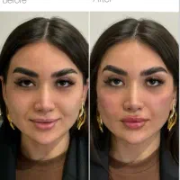 کاشت ابرو فیلر بوتاکس با ۵۰٪ تخفیف فقط هزینه