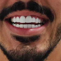 کامپوزیت دندان نقد و اقساط