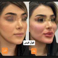 جشنواره‌تخفیف فیلر/ژل/بوتاکس/آنزیم/پزشک