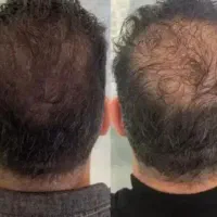 درمان ریزش مو و ریش تضمینی