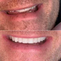 تخفیف گامپوزیت عصب کشی ترمیم