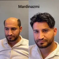 کلینیک پروتز مو ماردین عظمی