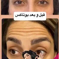 بوتاکس آنزیم فیلر ژل