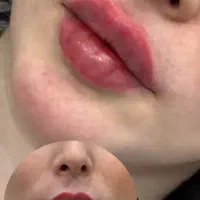 تخفیف تزریق ژل بوتاکس مزو
