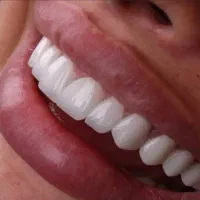 دندانپزشکی( ایمپلنت اوردنچر کامپوزیت دندان مصنوعی)